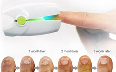 Portable Fungus Nail Laser DYLINOSHOP