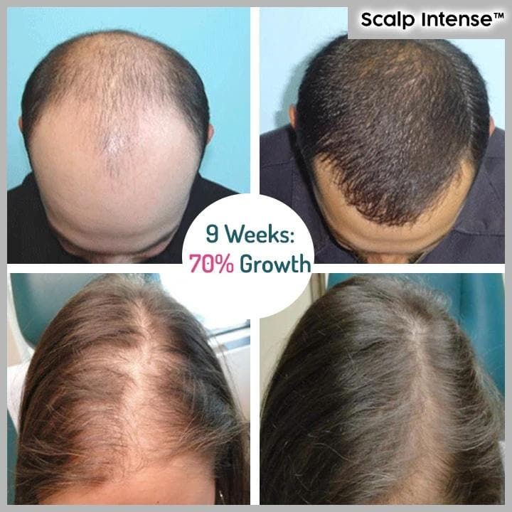 Scalp Intense™ - Hair Growth Serum dylinoshop