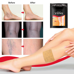 Varicose Veins Treatment Patch DYLINOSHOP